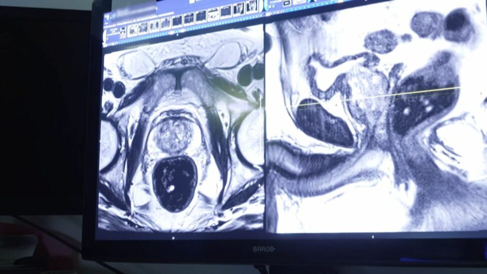 Sharp Rise In Prostate Cancer If 'tsunami' Of Cases Not Detected Sooner, Doctor Warns