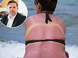 I applied factor 50 sun cream but still got badly burnt can i get compensation? consumer lawyer dean dunham replies