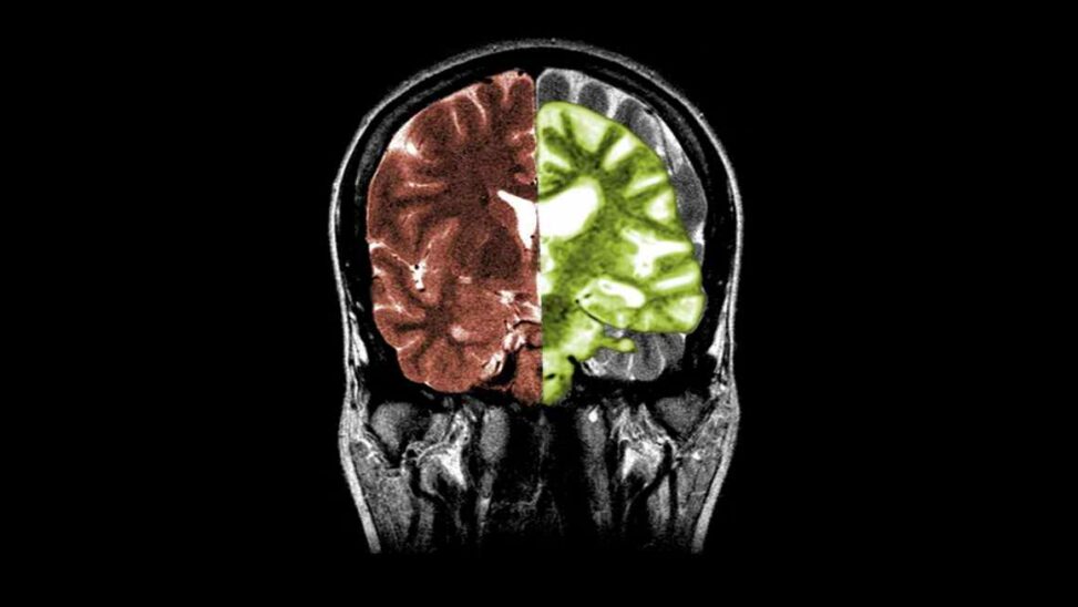 Proteins in human body reveal warning signs for alzheimer’s and parkinson’s