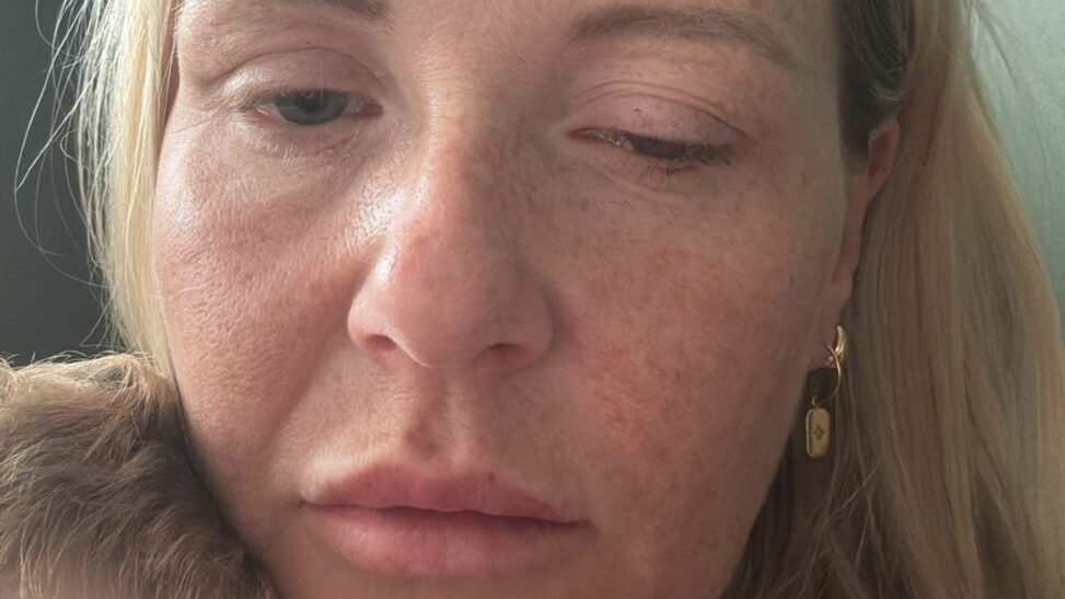 'it's the wild west': dozens of women develop botulism linked to anti wrinkle injections