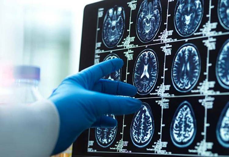 Fda recommends increased monitoring of alzheimer's patients on leqembi