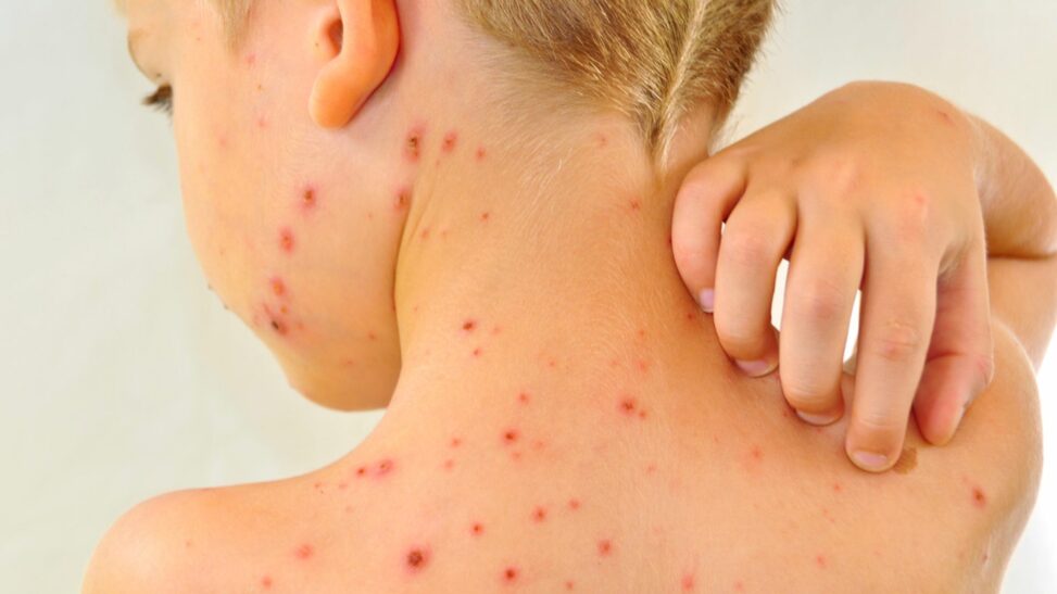 Chickenpox vaccine to be offered on nhs next year