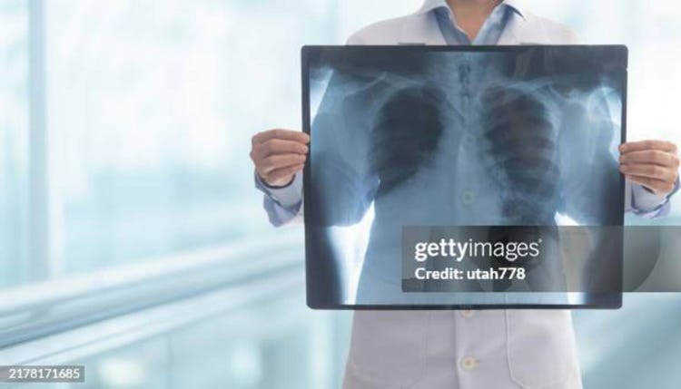 Astrazeneca fails to meet main goal in lung disease trial