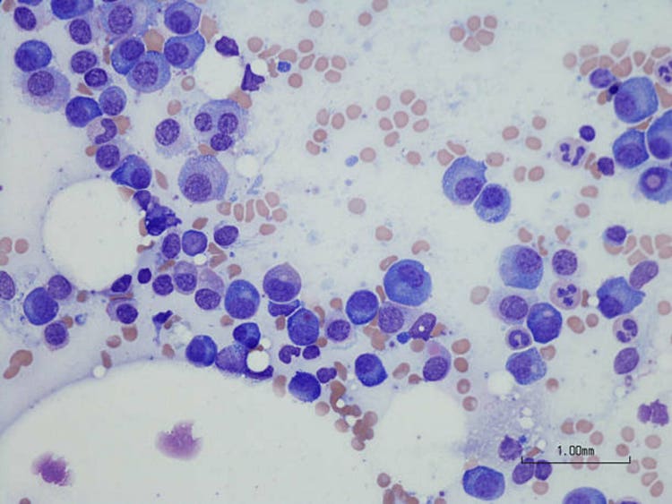 Johnson & johnson reports positive results from multiple myeloma trial