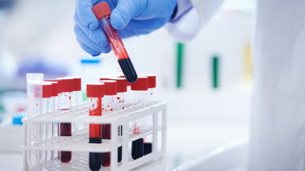 Uk patients to trial blood test that could 'revolutionise' alzheimer's diagnosis